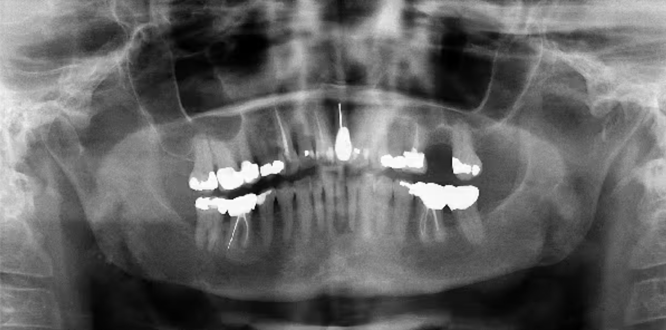 Ca lâm sàng bệnh lý miệng: Tổn thương di căn tại hàm dưới ở bệnh nhân có tiền sử ung thư nội mạc tử cung